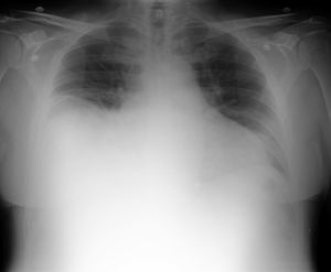 Radiografía posteroanterior de tórax del paciente. Derrame pleural derecho que ocupa hasta la mitad del hemotórax.