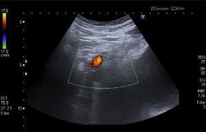 Ecografía Doppler de miembros inferiores del paciente. Signos de trombosis venosa profunda en vena ilíaca externa derecha, venas femorales común y superficial ipsolateral y vena poplítea derecha. Edema del tejido celular subcutáneo del miembro afectado.