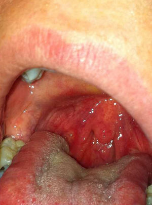 Lesiones aftosas en mucosa oral.