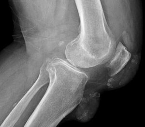 Artropatía con calcificaciones capsulares y erosión ósea en borde lateral del cóndilo femoral e incipiente condrocalcinosis en rodilla derecha.