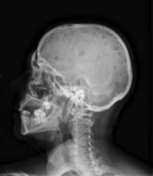 Radiografía lateral de cráneo: lesiones líticas «en sacabocados» o petrificación del hueso.