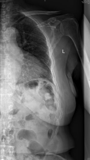 Radiografía costal anteroposterior izquierdo: patrón permeativo difuso en costillas, escápula y húmero.