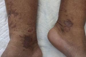 Lesiones que afectan de forma bilateral y asimétrica al tercio distal de las extremidades inferiores. Presenta una lesión activa en extremidad inferior derecha en forma de placa ovalada eritematosa y otras lesiones cicatriciales de bordes angulares y coloración blanco-nacarada.