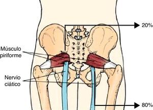Variaciones anatómicas del músculo piriforme (disponible en: www.juanluismaestrodeleon.com).