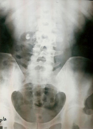 Radiografía del tracto urinario simple realizada en 2001 donde se observan ambos riñones fusionados por el polo inferior (compatible con riñón en herradura), imagen de litiasis en el polo inferior del riñón derecho.