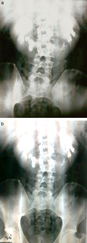 a y b. Urografía intravenosa del año 2001. En fase excretora se observan los ejes renales verticales y ambas pelvis renales malrotadas extrarrenales. En el nefrograma se constata la fusión de ambos riñones por el polo inferior, lo que constituye el itsmo.