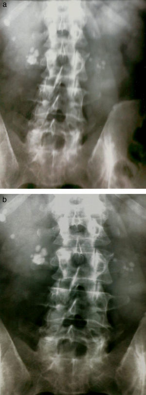 a y b. Radiografía del tracto urinario simple realizada en el año 2011, 10 años después de la LEOC, donde se observan múltiples imágenes de litiasis en ambos riñones.