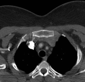 Angio-TC torácica: se aprecian engrosamiento circunferencial de troncos supraaórticos y oclusión de la arteria subclavia izquierda. Elaboración propia, imagen aportada por el servicio de radiodiagnóstico del Hospital Universitario de Getafe (Madrid).