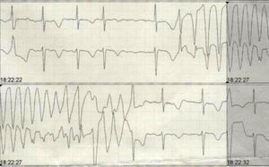 Monitorización electrocardiográfica.