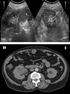 Superior: imagen ecográfica de riñón derecho en la que se observa en la zona interpolar-polo inferior, una masa de ecogenicidad heterogénea y morfología irregular. Inferior: la TC confirma la presencia de dicha tumoración, infiltrando el grupo calicial inferior y dudosamente la pelvis renal.