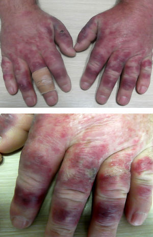 En cuadrante superior imagen panorámica con presencia de placas eritematovioláceas en dorso de ambas manos con tendencia a la confluencia, acompañadas de importante edema. En la imagen inferior se muestra detalle de la formación de incipientes ampollas de contenido purulento.