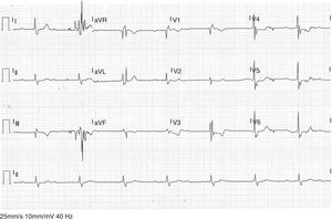 Electrocardiograma registrado durante el episodio: bloqueo auriculoventricular de segundo grado Mobitz I, bloqueo completo de rama derecha y hemibloqueo anterior izquierdo.