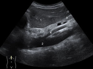 Corte longitudinal: Lóbulo hepático izquierdo (1), Arteria aorta (2), Páncreas (3) y Arteria mesentérica superior (4).