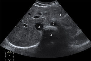 Corte transversal: Lóbulo hepático izquierdo (1), Vena cava inferior (2), Arteria aorta (3) y Cuerpo vertebral (4).