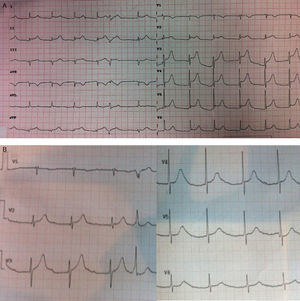 A) ECG del paciente a su llegada a urgencias: obsérvese el ascenso difuso del segmento ST desde V2-V6 y en i, ii, iii, aVL, aVF, que era más compatible con pericarditis que con lesión de múltiples territorios. B) ECG 3 min más tarde que muestra práctica normalización del ST y aparición nueva de un BAV 1.ocon PR muy largo, probablemente por afectación de la coronaria derecha.