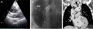 Técnicas de imagen para el diagnóstico. A) Ecocardiograma transtorácico: se observan 2 imágenes lineales ecodensas y paralelas en el interior de la luz aórtica (flechas) que además presentaban movimiento independiente de la pared y que eran compatibles con flap de la íntima. B) Aortografía: las flechas señalan las líneas de disección y el flap en una aorta muy dilatada (65mm). Obsérvese que no hay relleno no selectivo de las arterias coronarias que tienen afectada su perfusión por el flap. C) Angio-TC: las flechas señalan las líneas de disección con afectación de aorta ascedente y troncos supraórticos. Ao: Aorta; AI: aurícula izquierda; Crtd: carótida; VD: ventrículo derecho; VI: ventrículo izquierdo.