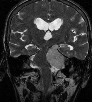 RM coronal en T1: se aprecia meningioma en ángulo pontocerebeloso izquierdo con desplazamiento importante de tronco del encéfalo a la derecha y aumento ventricular de carácter leve.