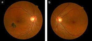 Retinografía donde observamos: a) Lesión cicatricial toxoplásmica en ojo derecho. b) Ojo izquierdo sano.