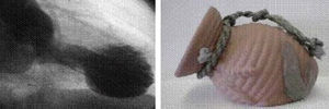 A la derecha, antiguo recipiente con que los pescadores japoneses capturaban los pulpos (en japonés tako significa «pulpo» y tsubo, «recipiente»). A la izquierda, imagen sistólica del ventrículo izquierdo en la ventriculografía, en la que se observa discinesia anteroapical con hipercinesia basal, característica del síndrome de Tako-Tsubo.