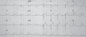 El electrocardiograma (ECG) inicial puede ser similar al del SCA con elevación del segmento ST en precordiales, ondas T negativas en precordiales y onda Q, siendo rara la imagen especular en cara inferior.