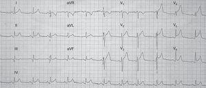 El electrocardiograma (ECG) inicial puede ser similar al del SCA con elevación del segmento ST en precordiales, ondas T negativas en precordiales y onda Q, siendo rara la imagen especular en cara inferior.