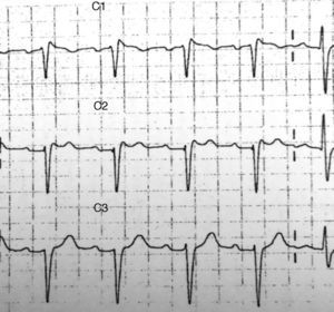Ritmo sinusal a una frecuencia de 94 latidos por minuto. Bloqueo incompleto de rama derecha. Elevación submilimétrica del ST con morfología «en silla de montar» en V1-V2 compatible con patrón de Brugada tipo ii.