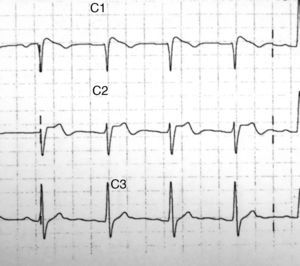 ECG con bloqueo incompleto de rama derecha del haz de Hiss con elevación del ST descendente de 1,5-2mm con T negativa en V1 y elevación del ST «en silla de montar» en V2.