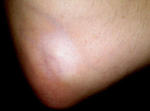 Atrofia e hipopigmentación cutánea secundaria a infiltración con corticoides.