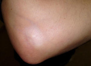 Fragilidad cutánea secundaria a infiltración con corticoides.