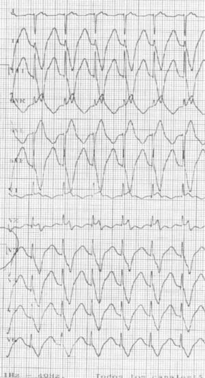 ECG a la entrada en consulta. El voltaje está reducido a la mitad para evitar la superposición de los trazados, observándose las espigas del marcapasos antes del complejo QRS.