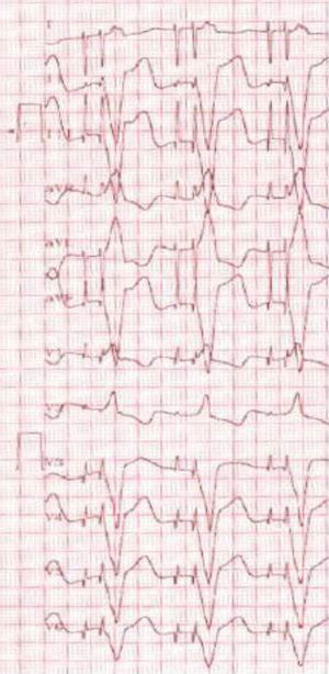 ECG tras aplicación del imán. Pueden observarse las 2 espigas de la estimulación bicameral.