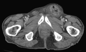 TC abdominal.