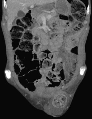 TC abdominal.