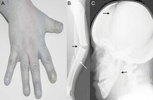 El paciente presentaba una estatura baja, fascies sindrómica, uñas distróficas, manos y dedos pequeños (A). El estudio radiográfico inicial de la pierna del paciente presentaba una fractura de tercio medio de tibia y peroné transversa pura, sobre un hueso con corticales muy gruesas y gran masa ósea (B). Se completó el estudio radiográfico con una radiografía de cráneo para confirmar el diagnóstico de picnodisostosis, donde se puede observar un ángulo mandibular obtuso, y las fontanelas craneales abiertas (C).