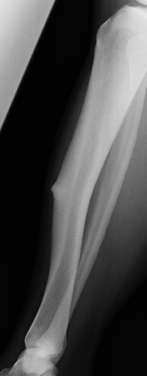 En la exploración física del paciente se evidenció deformidad en la pierna afectada y tumoración sólida en el tercio medio de la pierna contralateral correspondiente a un engrosamiento de la cortical anterior de la tibia, consecuencia de una fatiga crónica.