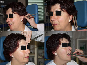 Los 2 pasos del test de Rinne (a y b). Primero, el diapasón en vibración sobre la mastoides y luego a 2cm del conducto auditivo externo. Abajo, test de Weber (c y d). El vástago del diapasón se puede posicionar en la línea media de la frente o entre los dientes.