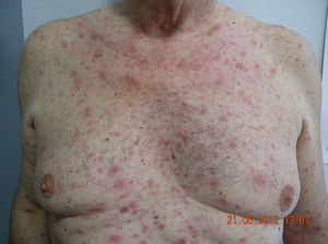 Lesiones eritematosas maculopapulosas, algunas de ellas erosivas, diseminadas en toda la superficie corporal (también palmas de las manos y plantas de ambos pies).