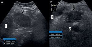 Masa epigástrica en el caso 1 (A) y masa en páncreas del caso 2 (B), señaladas con las marcas. Estructuras de referencia: hígado (1), aorta (2).