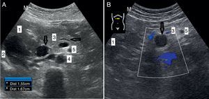 Dilatación del colédoco y el conducto de Wirsung del caso 3 (A) e imagen hipoecogénica en cabeza de páncreas en el caso 4 (B), señaladas por las flechas. Estructuras de referencia: hígado (1), vesícula biliar (2), páncreas (3), aorta (4) y arteria mesénterica superior (5).