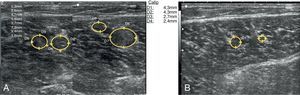 A) Imagen ecográfica con sonda lineal de 13 MHz que corresponde a un corte transversal en el tercio medio del vientre medial del gemelo del miembro inferior derecho. Imagen a doble pantalla donde se detectan 4 imágenes redondeadas, ecogénicas, medidas en sus ejes anteroposterior y transversal que corresponden a 4 venas gemelares distendidas y ocupadas completamente de material ecogénico correspondiente al trombo. B) Mismo corte ecográfico realizado dos meses después donde pueden observarse dos imágenes redondeadas que corresponden a dos venas gemelas trombosadas, medidas en sus ejes anteroposterior y transversal y con una clara disminución de tamaño respecto a la figura 1A.