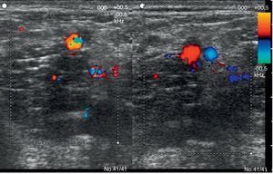 Imagen correspondiente a ecografía Doppler con sonda lineal de 13 MHz. Imagen a doble pantalla. La pantalla de la derecha corresponde a un corte transversal a nivel del tercio proximal del vientre medial del gemelo del miembro inferior derecho. Se detecta una imagen redondeada que capta flujo correspondiente a una arteria gemelar, y profunda a la misma una imagen peor delimitada hipoecogénica que corresponde a la vena gemelar trombosada que no capta flujo. La pantalla de la izquierda corresponde a un corte tranversal algo más proximal, cerca ya del hueco poplíteo y pueden apreciarse 2 imágenes redondeadas que captan flujo Doppler y corresponden a la arteria y vena gemelares, cerca ya de su unión a los vasos poplíteos.