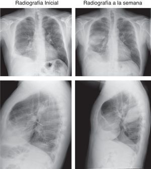 Evolución de las lesiones pulmonares en estudios radiológicos de tórax al inicio y a la semana.