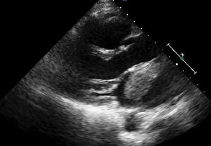 Ecocardiograma en eje largo paraesternal en el que se aprecia la masa en la aurícula izquierda en sístole.