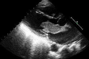 Ecocardiograma en eje largo paraesternal con la masa prolapsando en diástole hacia el ventrículo izquierdo, originando una obstrucción intermitente a nivel de la válvula mitral.