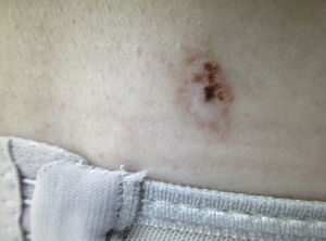 Imagen ampliada de la lesión.