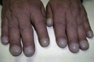 Acropaquias.