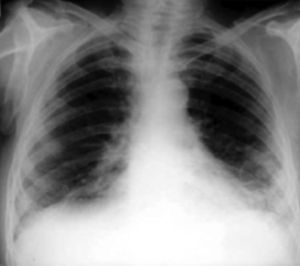 Radiografía de tórax en la FPI. Imágenes reticulares bibasales y simétricas.
