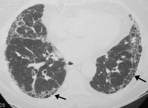 TACAR en la FPI. Patrón reticular de localización subpleural y presencia de múltiples quistes de pequeño tamaño que representan áreas de panalización asociada (flechas).