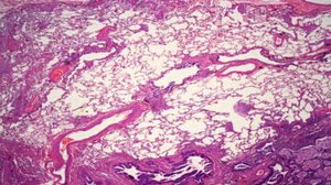 Patrón de neumonía intersticial usual en la biopsia pulmonar: fibrosis periférica con focos de actividad fibroblástica en áreas e interfase y focos de micropanal.
