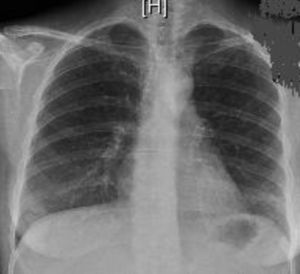 Radiografía de tórax al alta con un parénquima pulmonar sin alteraciones.